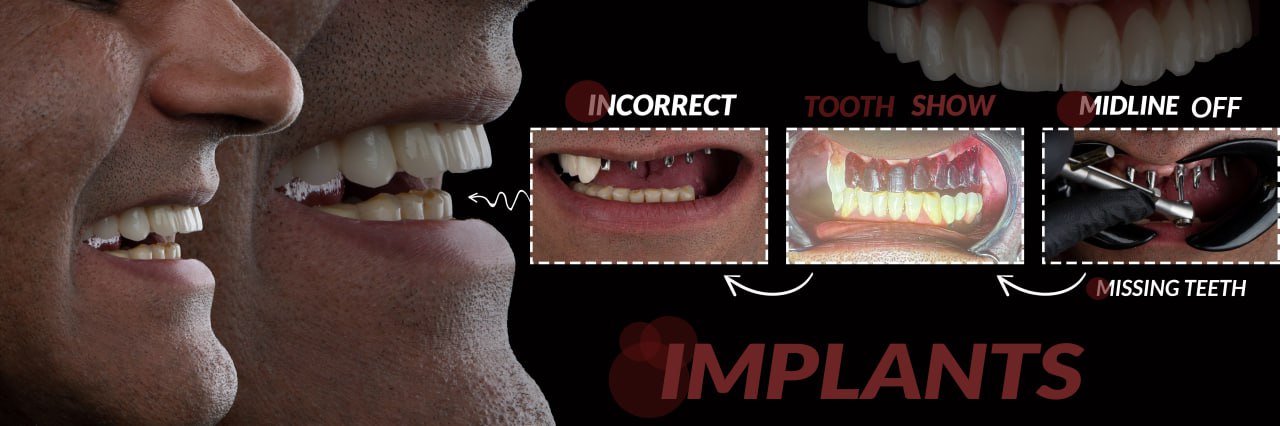 فناوری‌ های پیشرفته در ایمپلنت دندان