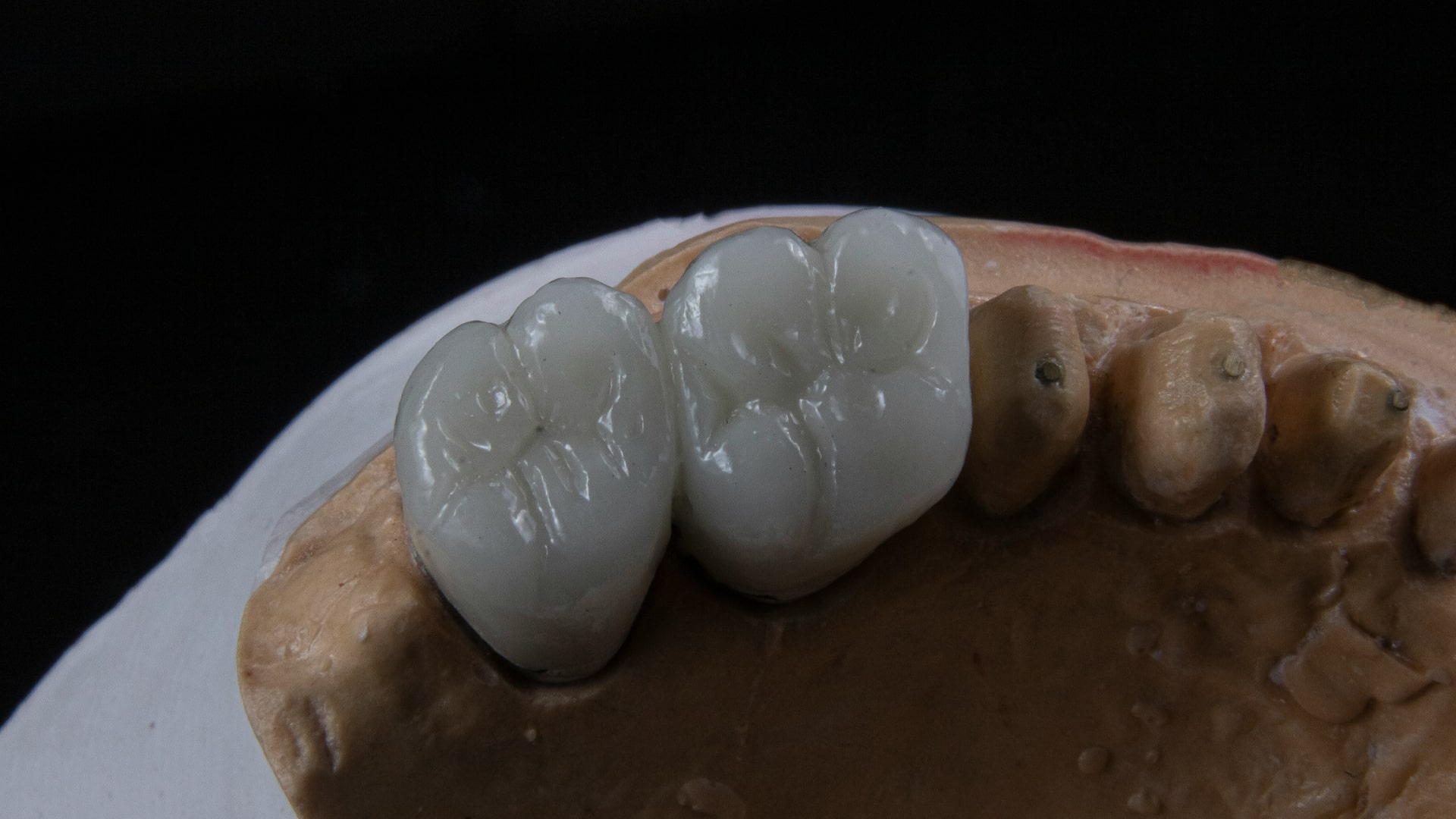 دندان مصنوعی جزئی